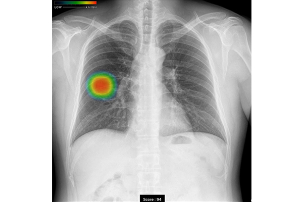 AI画像診断(胸部X線画像の読影サポート)