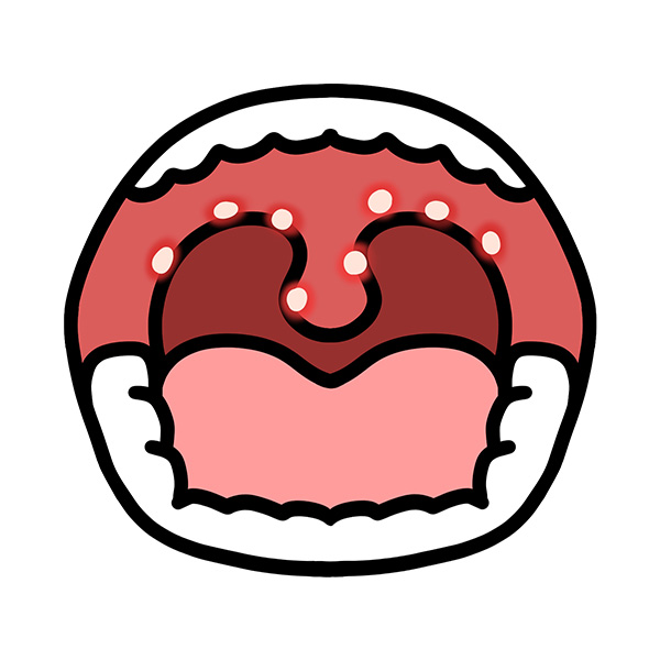 ヘルパンギーナ